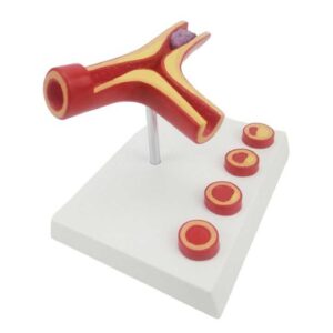 דגם כלוסטרול בדם